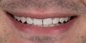 Antes - Diastema